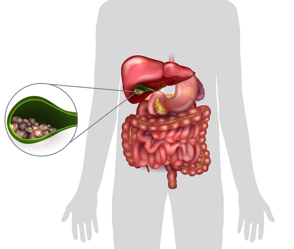 Car Accident Cause Gallbladder Problems