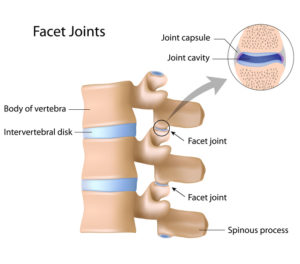 Can a Car Accident Cause Facet Arthropathy?