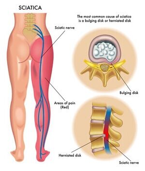 Can a Car Accident Cause Sciatica?