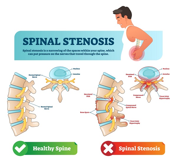 Can a Car Accident Cause Spinal Stenosis?