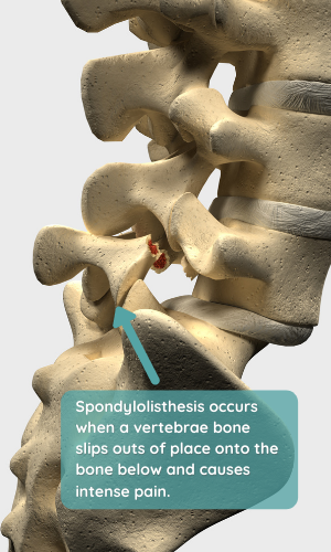 Can a Car Accident Cause Spondylolisthesis?