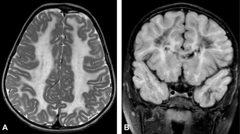 Can a Car Accident Cause White Matter Disease?