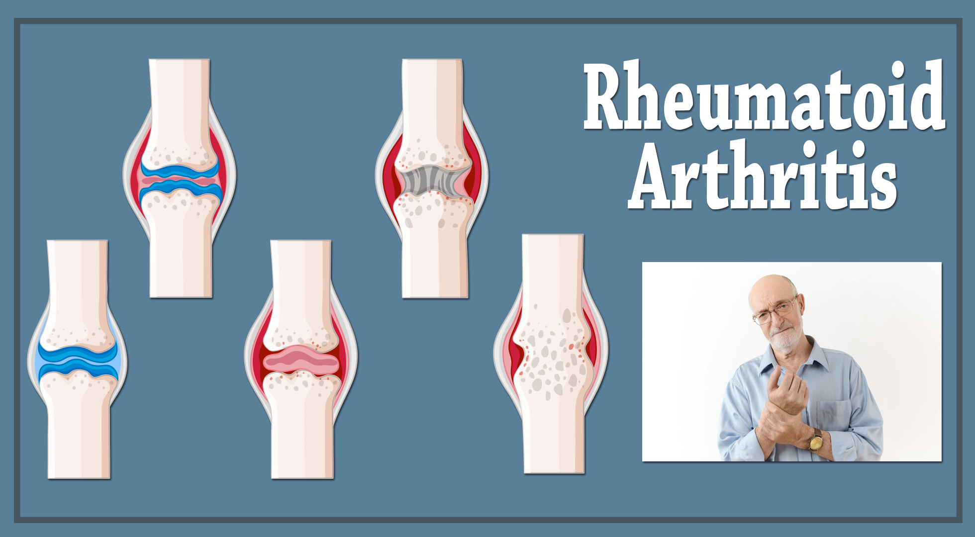 Can a Car Accident Trigger Rheumatoid Arthritis?