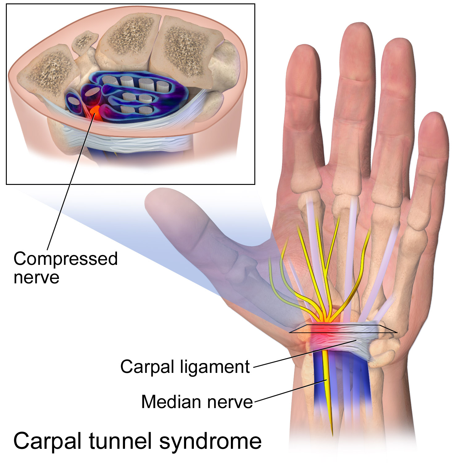 Can Carpal Tunnel Syndrome Be Caused by a Car Accident?