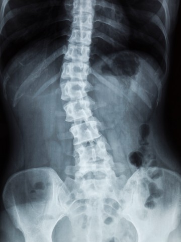 Can Scoliosis Be Caused by Car Accident?