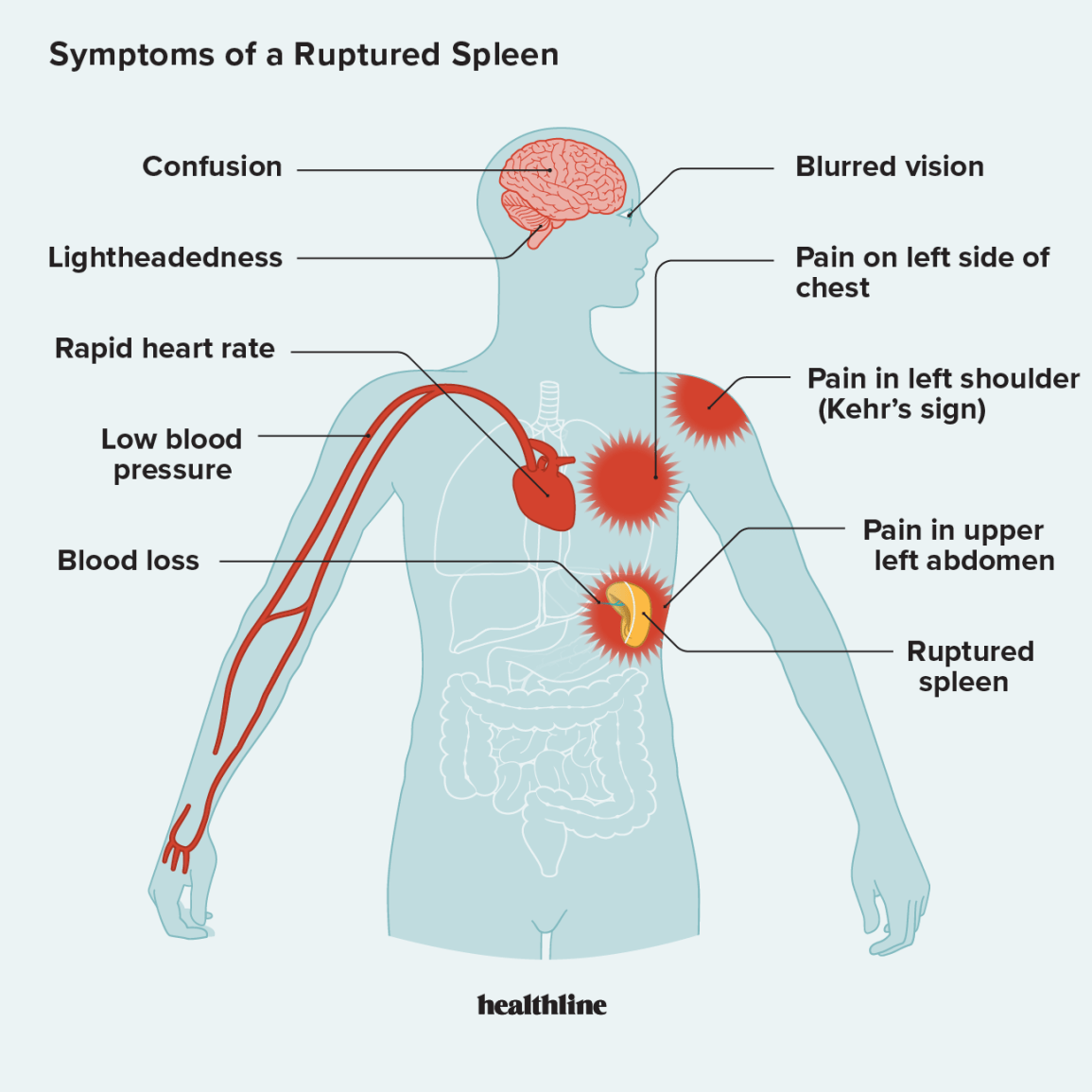 Can Slipping and Falling Cause Spleen Injury?