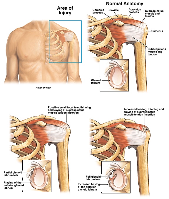 Can You Tear Your Rotator Cuff in a Car Accident?