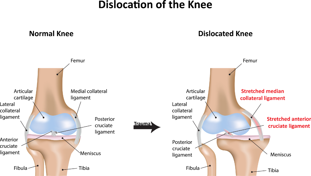 When You Slip and Fall and Dislocate Your Knee?