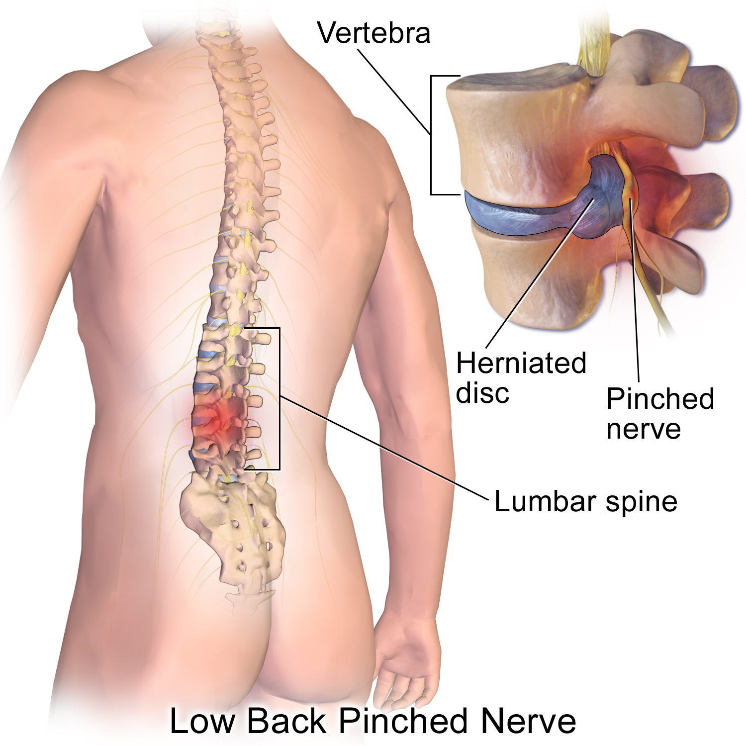 Why Does My Lower Back Hurt After a Car Accident?